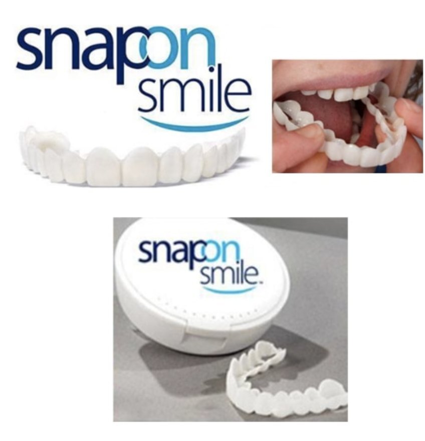 Snap-On Veneers